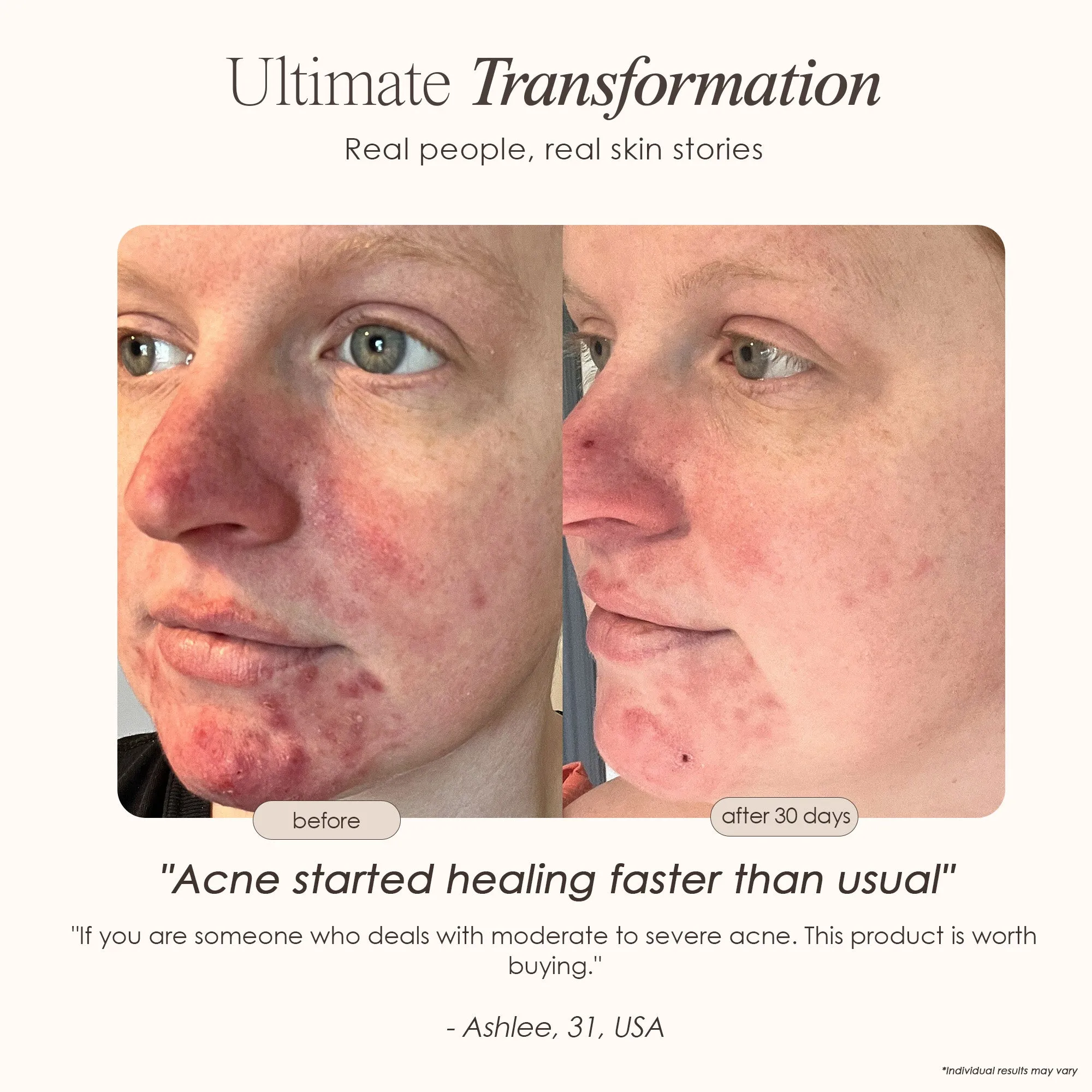 LightAura Plus | LED Face & Neck Mask
