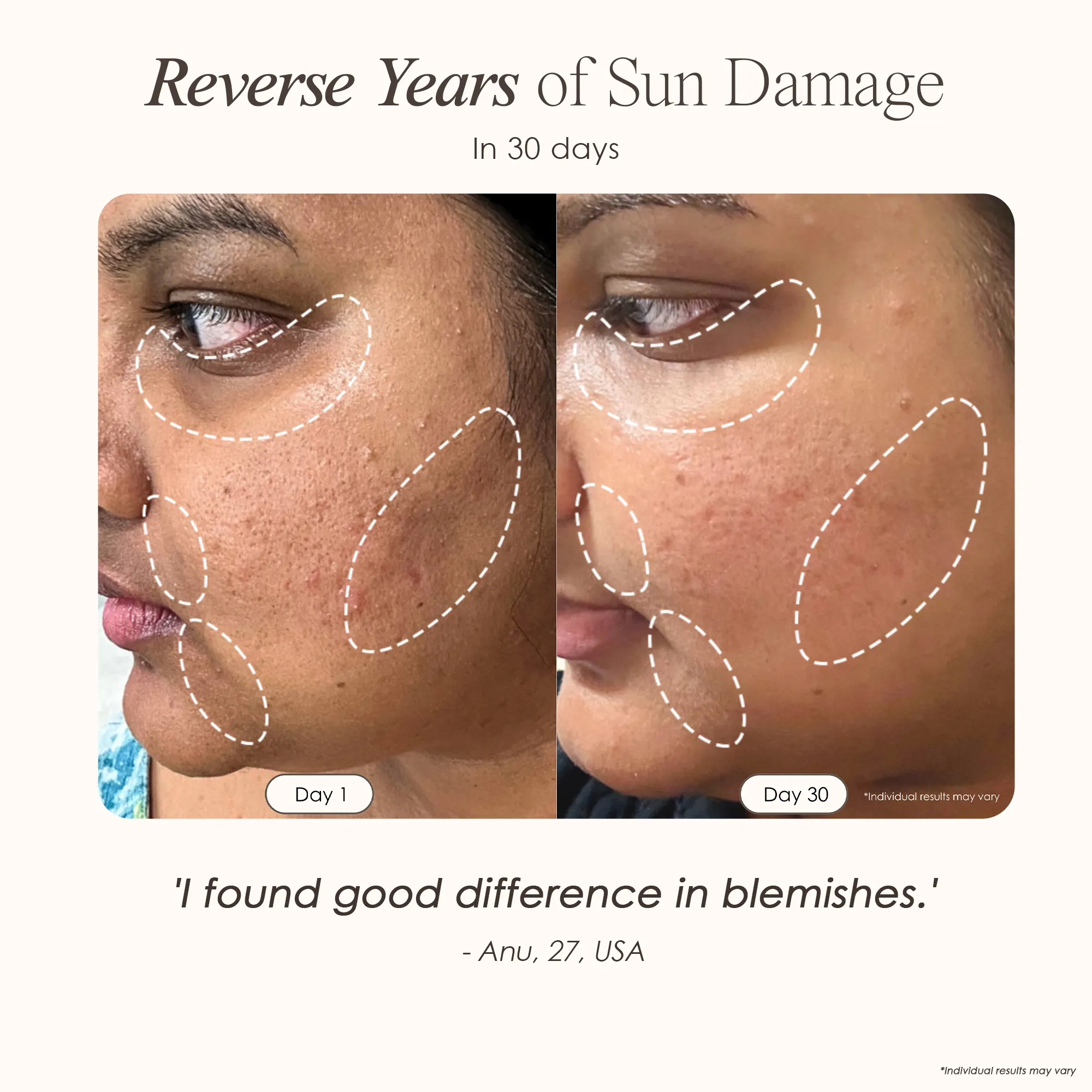 Lumamask Pro | LED Light Therapy Face Mask