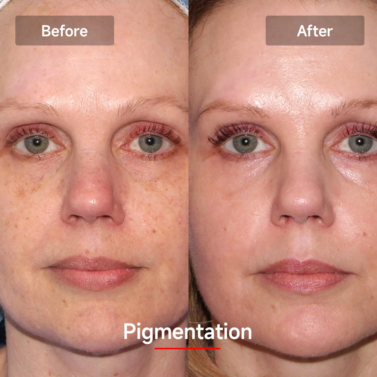 Megelin LASER&LED Light Therapy Mask