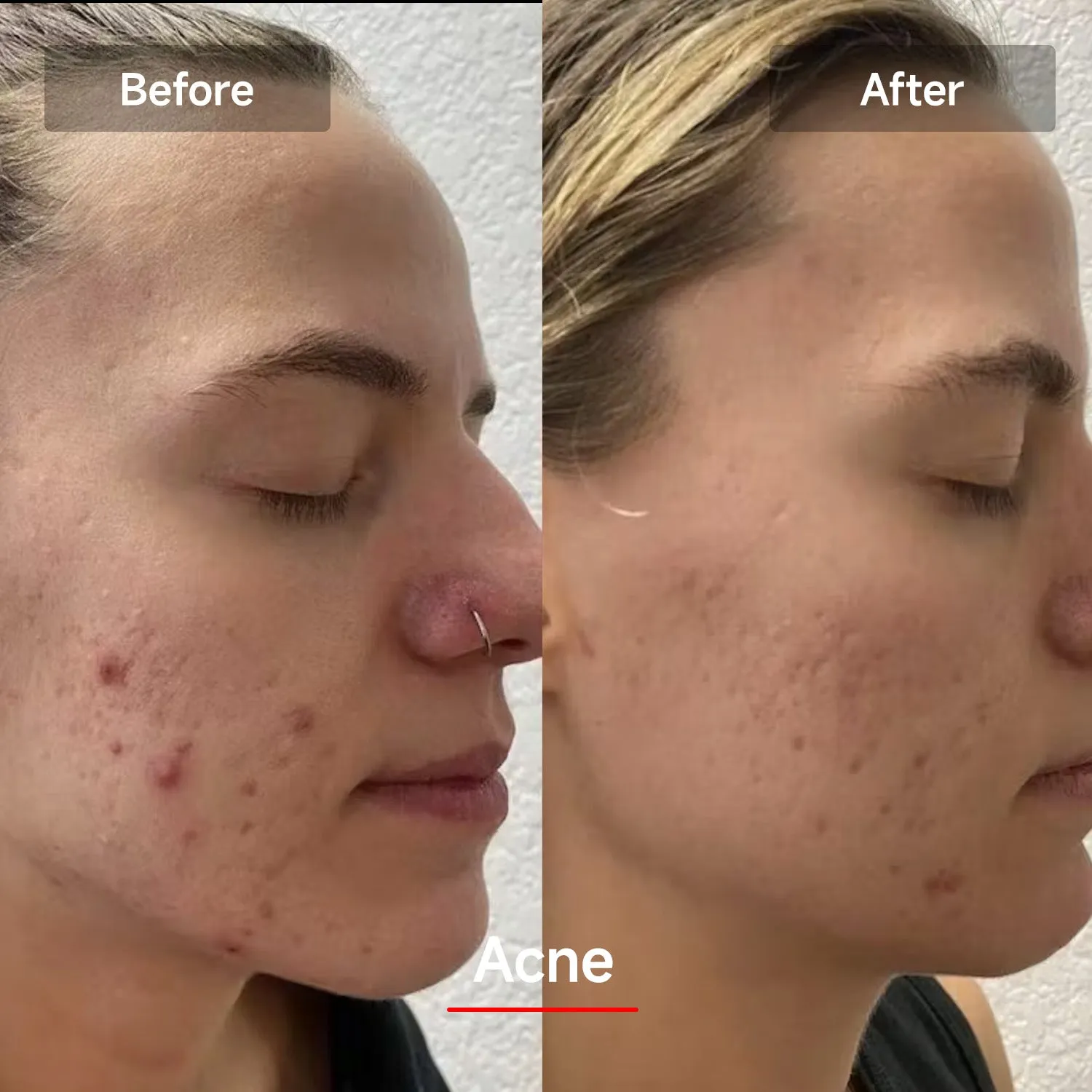 Megelin LED Red Light Therapy Face Mask
