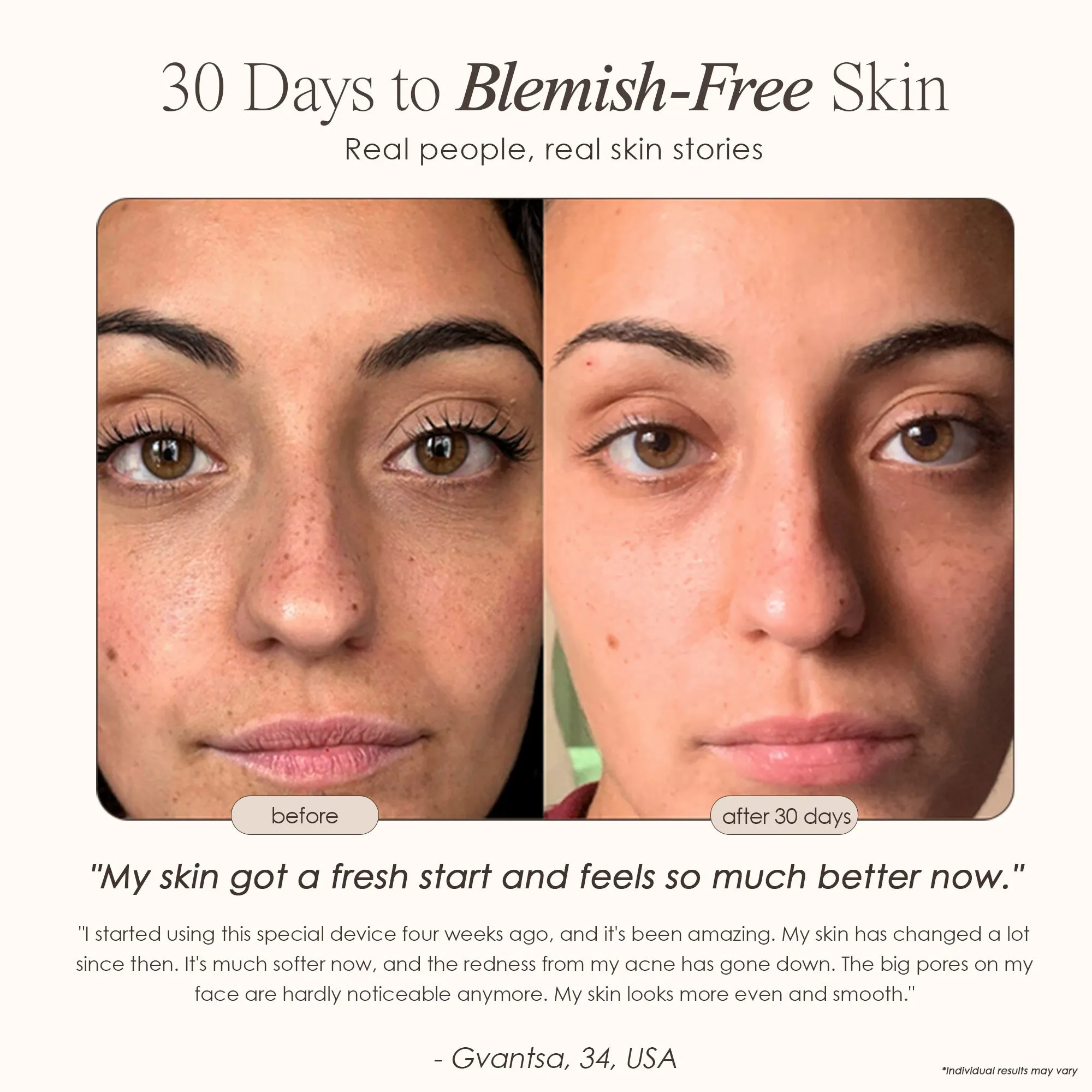 Reinvo | Facial Microdermabrasion Wand